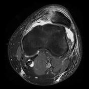 Medial Patellofemoral Ligament Injury | Radiology Reference Article ...