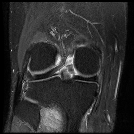 Posterior cruciate ligament tear | Radiology Reference Article ...