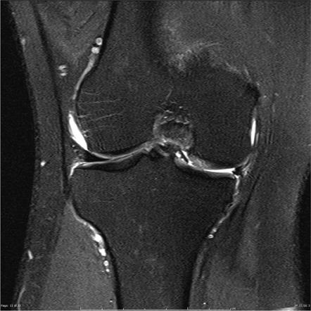 Wrisberg rip and medial meniscal bucket handle tear | Image ...