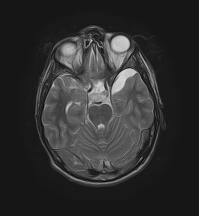 Arachnoid cyst | Image | Radiopaedia.org