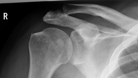 Rotator cuff calcific tendinopathy | Radiology Case | Radiopaedia.org