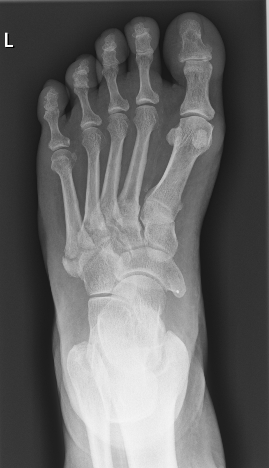 Avulsion fracture fifth metatarsal | Image | Radiopaedia.org