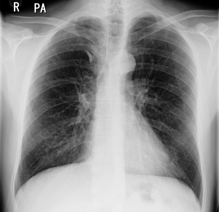 Azygos lobe | Radiology Case | Radiopaedia.org