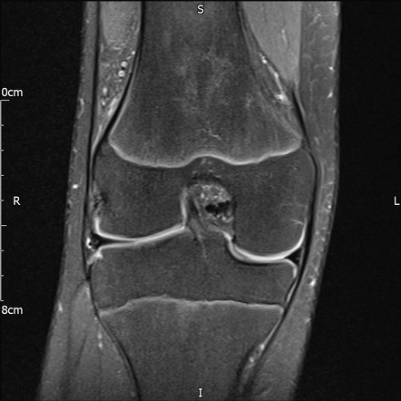 Transient lateral patellar dislocation | Image | Radiopaedia.org