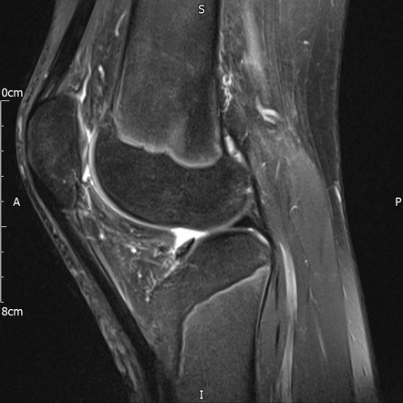 Transient lateral patellar dislocation | Image | Radiopaedia.org