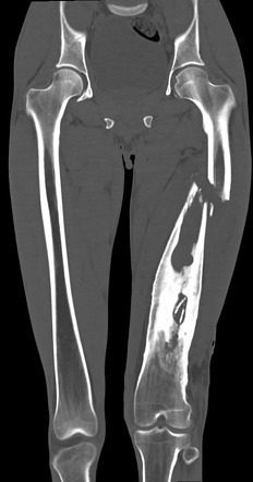 Chronic Osteomyelitis Radiology Reference Article Radiopaedia Org