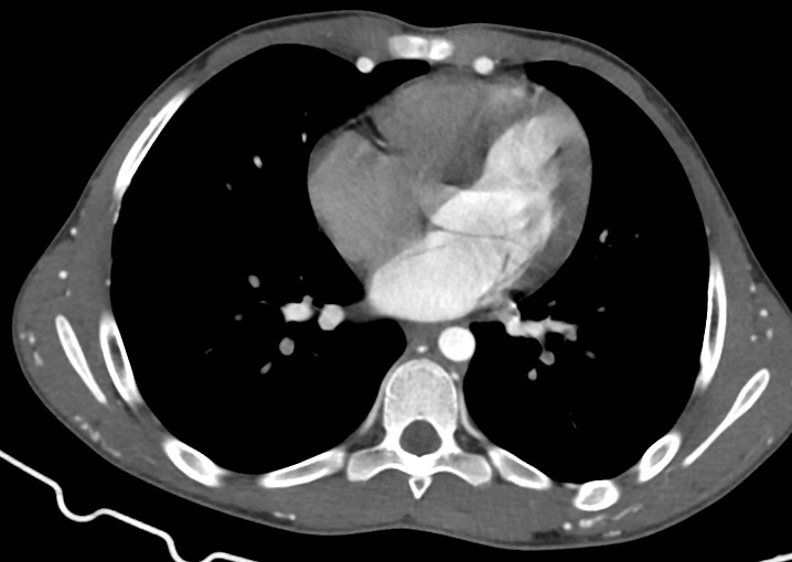 Aortic coarctation | Image | Radiopaedia.org