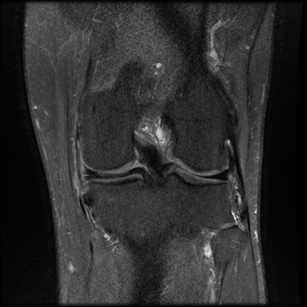 Parrot beak meniscal tear | Image | Radiopaedia.org