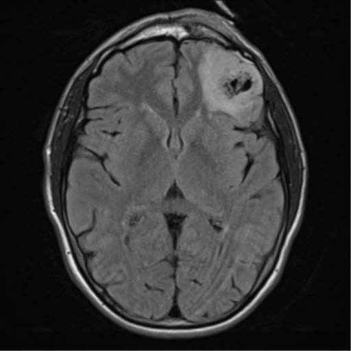 Oligodendroglioma (grade 3) with skull fracture | Image | Radiopaedia.org