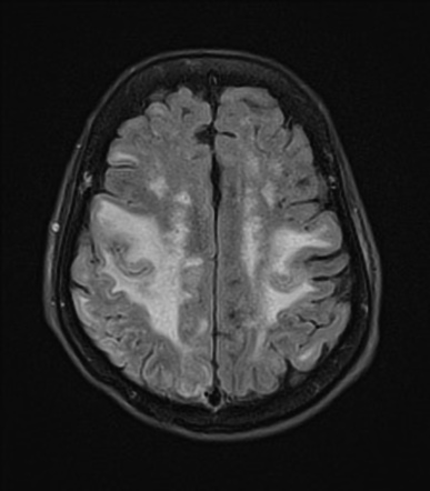 Inflammatory Cerebral Amyloid Angiopathy | Radiology Reference Article ...