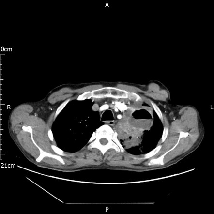 Lung abscess | Radiology Reference Article | Radiopaedia.org