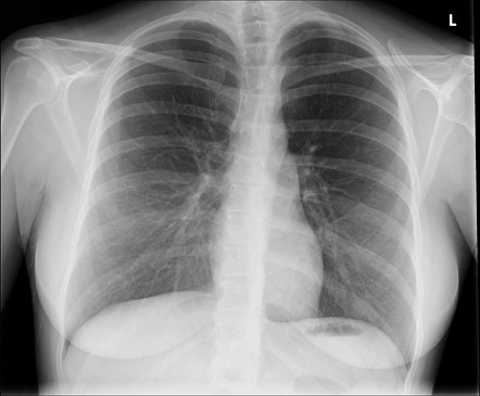 Continuous diaphragm sign | Image | Radiopaedia.org