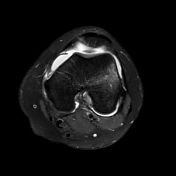 Medial Patellofemoral Ligament Injury | Radiology Reference Article ...