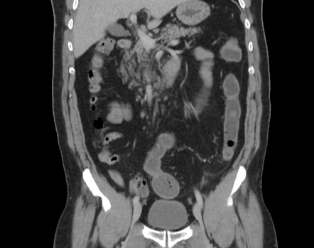 Sigmoid diverticulitis with microperforation | Image | Radiopaedia.org