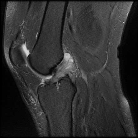 Anterior cruciate ligament mucoid degeneration | Radiology Reference ...