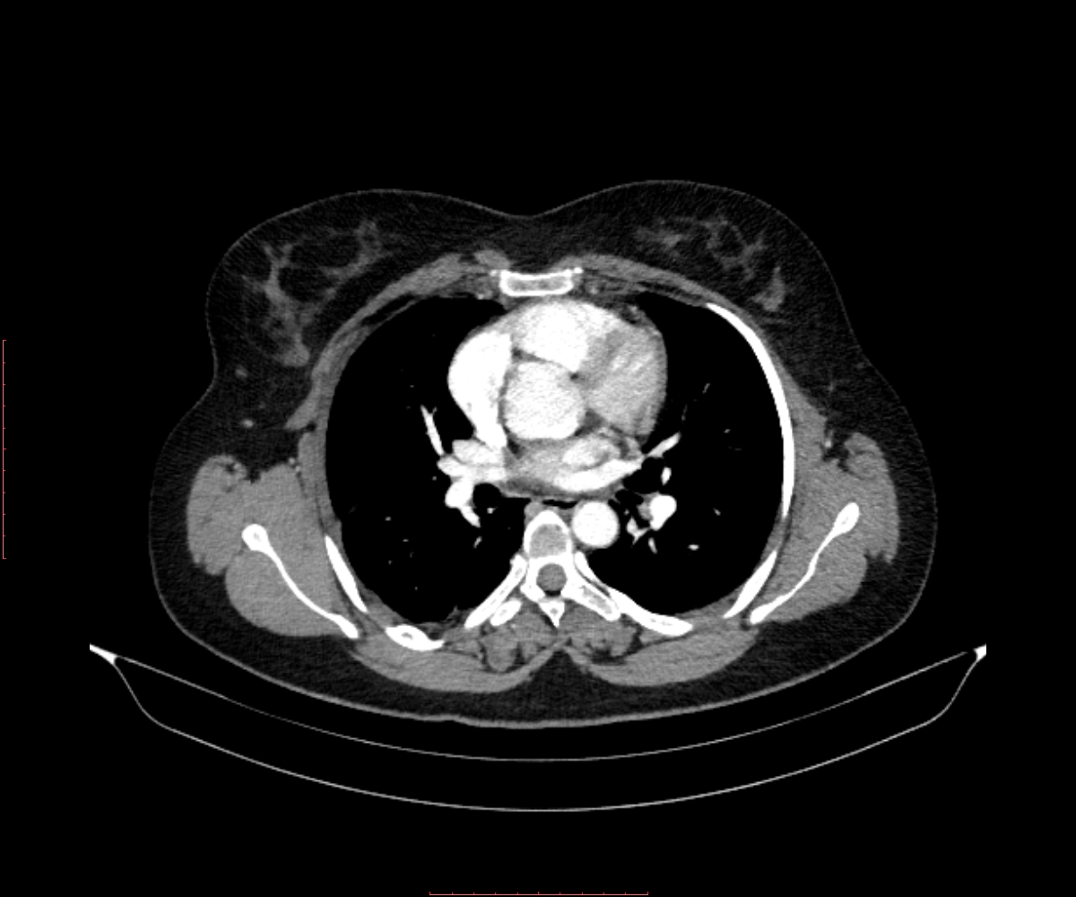 Fibrothorax | Image | Radiopaedia.org