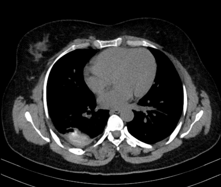 Fibrothorax | Radiology Case | Radiopaedia.org