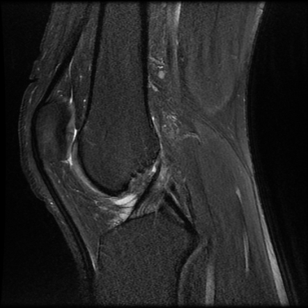 Ligamentum mucosum (infrapatellar plica) | Image | Radiopaedia.org