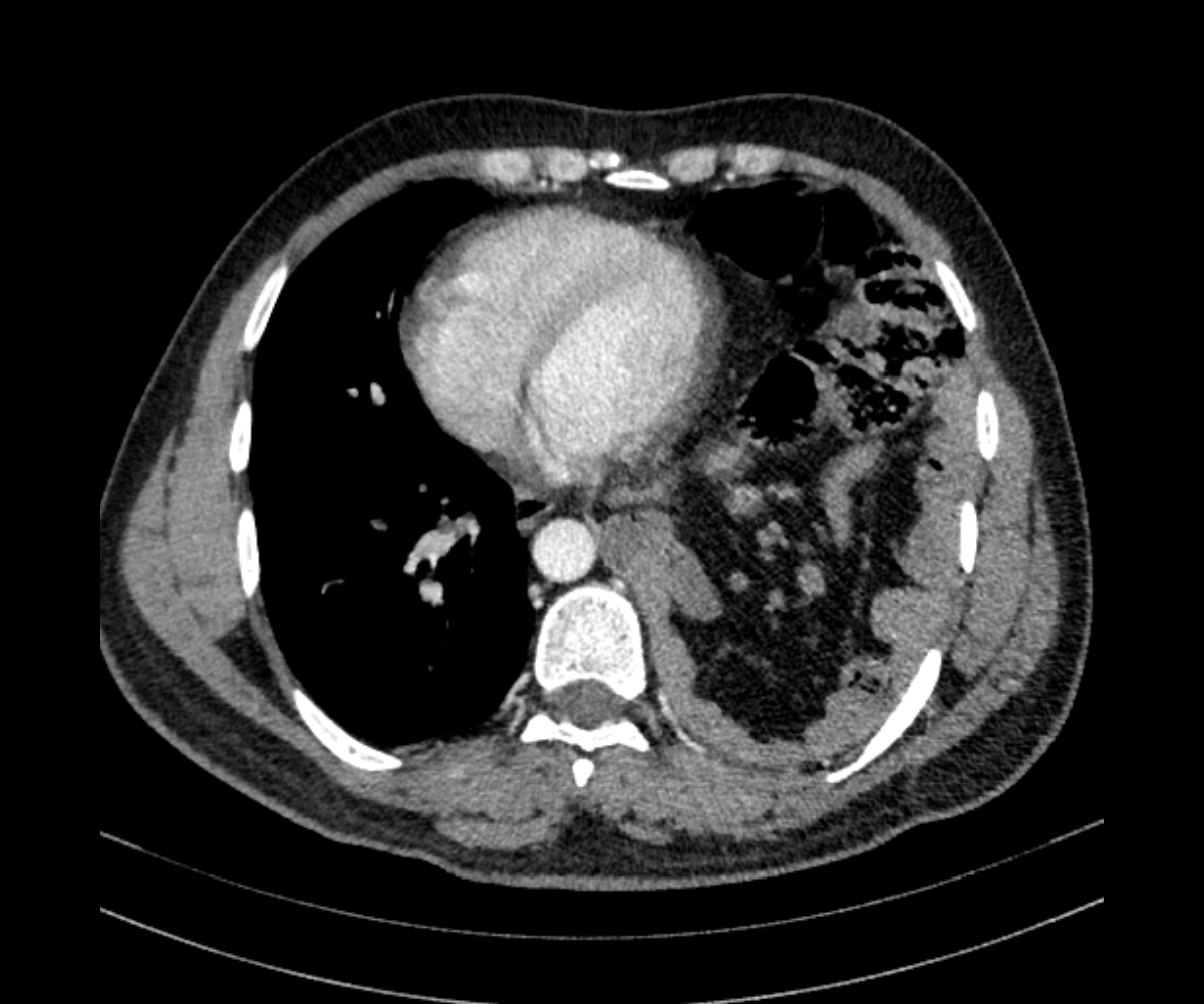 Bochdalek Hernia Adult Presentation Image