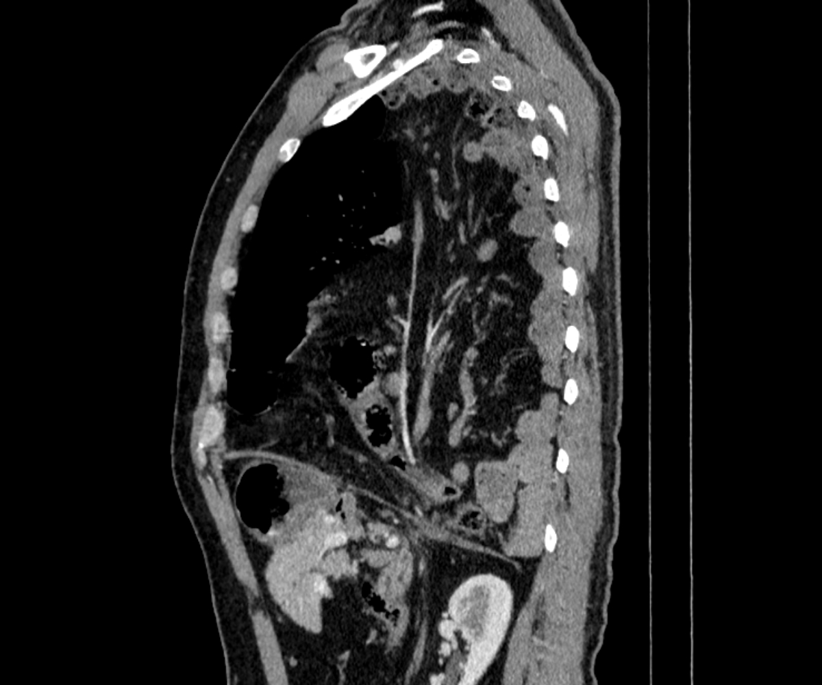 Bochdalek hernia - adult presentation | Image | Radiopaedia.org