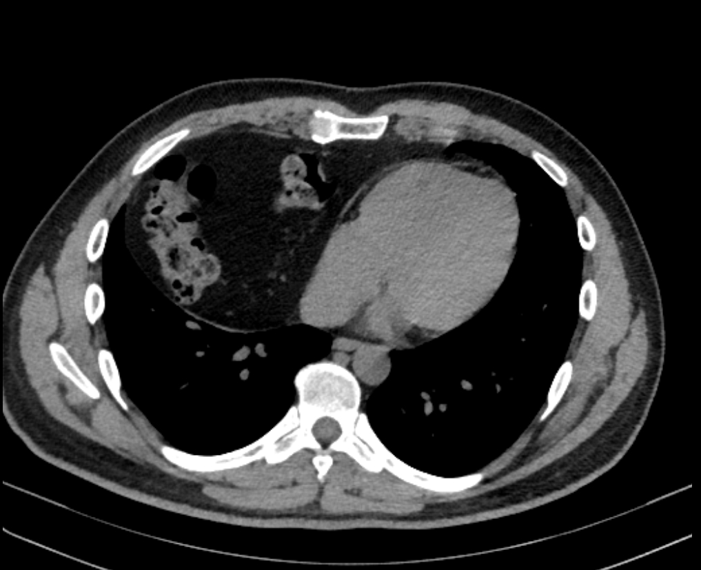 Morgagni hernia - adult presentation | Image | Radiopaedia.org