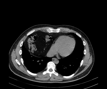 Morgagni hernia | Radiology Reference Article | Radiopaedia.org