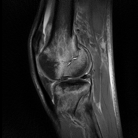 Hoffa Fracture Radiology Reference Article Radiopaedia Org