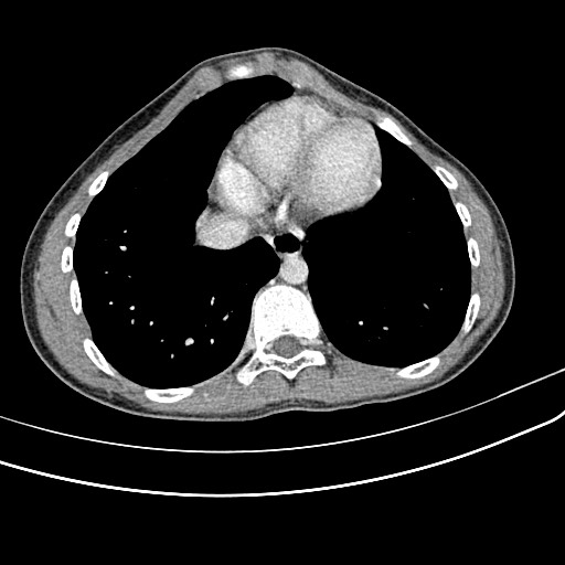 Pectus Carinatum Image Radiopaedia Org