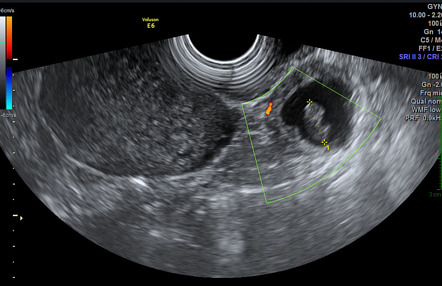 Ectopic Pregnancy 