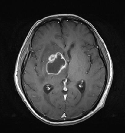 Playlist 'Ring enhancing brain lesions' by Dr Ahmed Abdelrahman