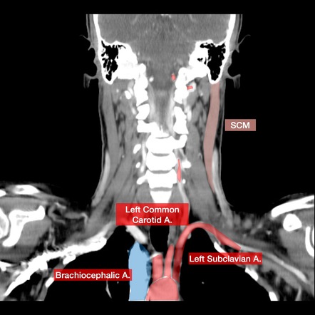 CT neck with annotated scrollable images | Image | Radiopaedia.org