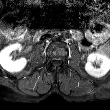 Chordoma - lumbar spine | Image | Radiopaedia.org