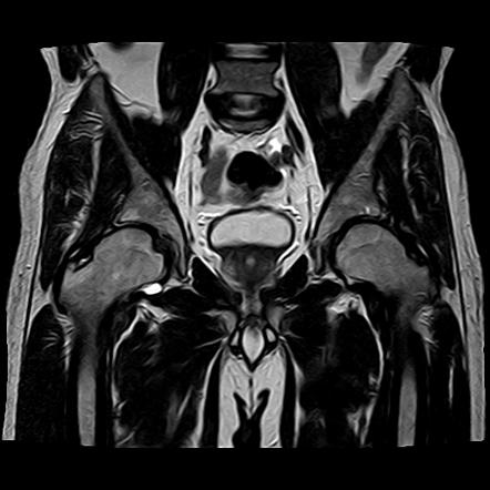 Femoroacetabular Impingement - Mixed Type | Image | Radiopaedia.org