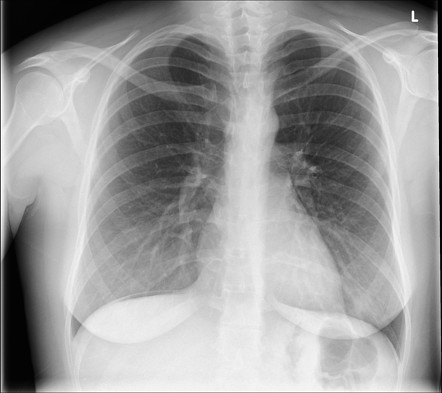 Small pneumoperitoneum | Radiology Case | Radiopaedia.org