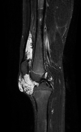 Synovial hemangioma - knee | Radiology Case | Radiopaedia.org