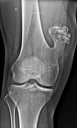 Osteochondroma - distal femur | Image | Radiopaedia.org