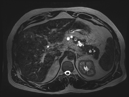 Intraductal papillary mucinous neoplasms - side branch type | Radiology ...