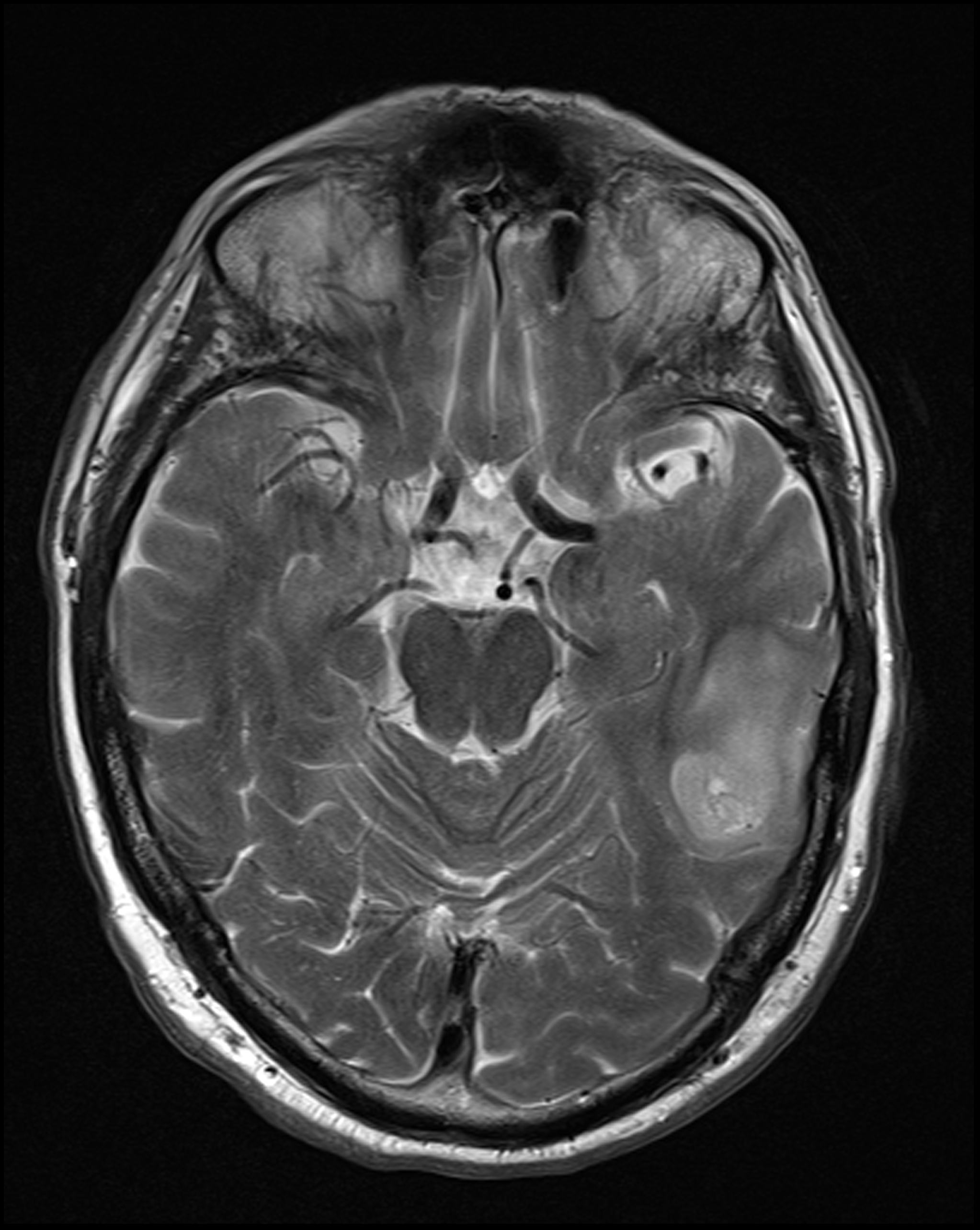 Glioblastoma - early | Image | Radiopaedia.org