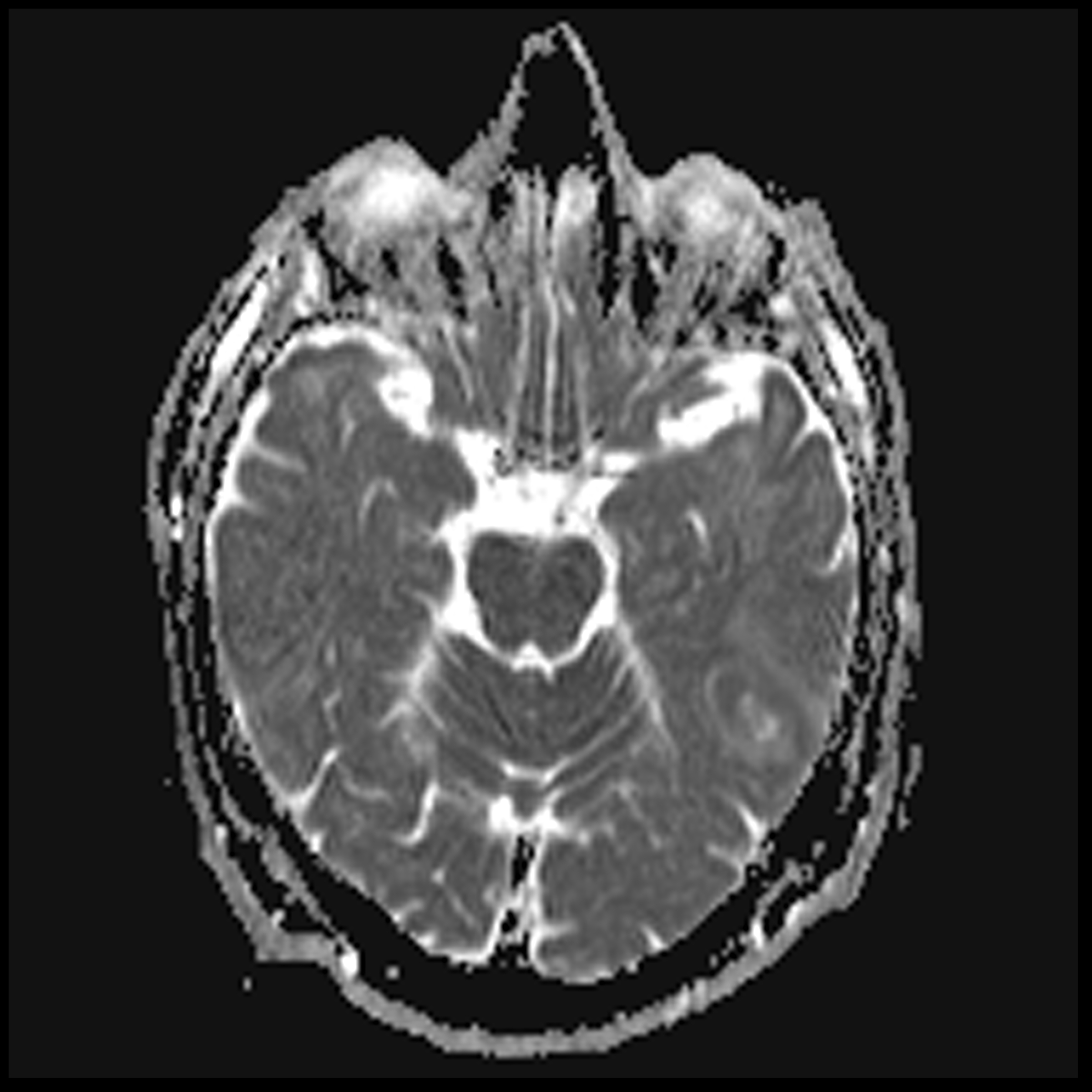 Glioblastoma - early | Image | Radiopaedia.org