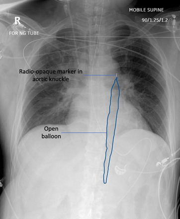 Intra Aortic Balloon Pump X Ray