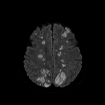 Thromboembolic Stroke From Aortic Arch Replacement | Radiology Case ...