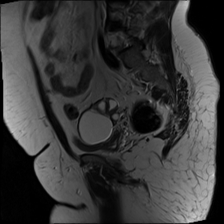 Hydrosalpinx - bilateral | Radiology Case | Radiopaedia.org