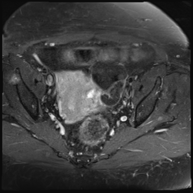 Hydrosalpinx - bilateral | Image | Radiopaedia.org