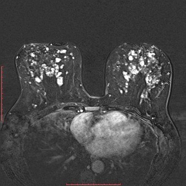 Multiple fibroadenomas and fibrocystic disease | Image | Radiopaedia.org