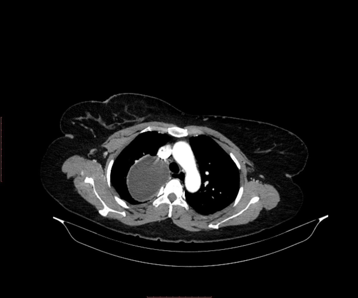 Foregut Duplication Cyst Image