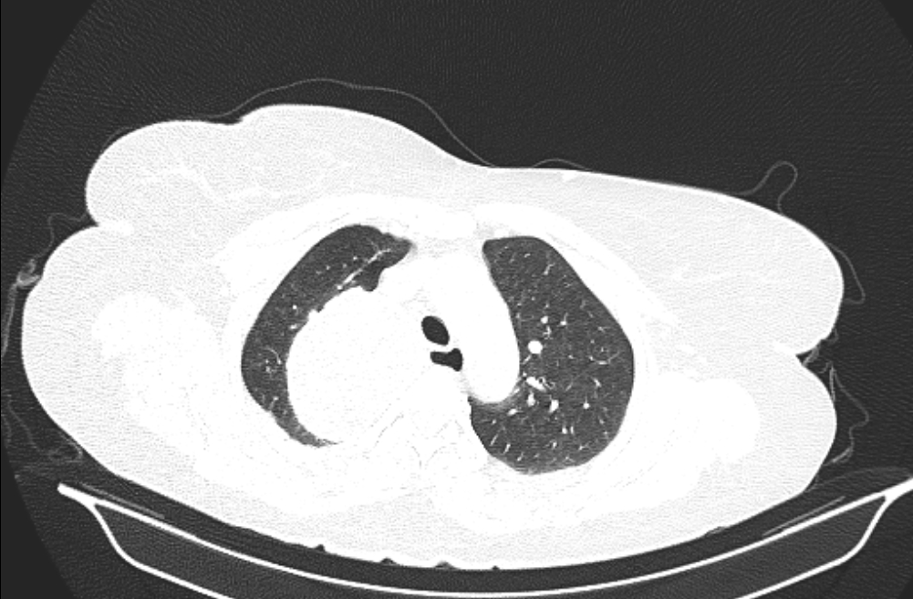 Foregut Duplication Cyst Image