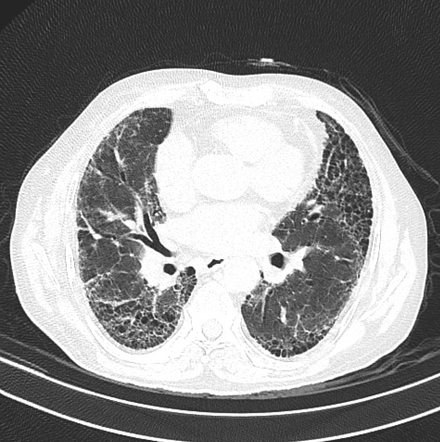 Usual interstitial pneumonia | Radiology Reference Article ...