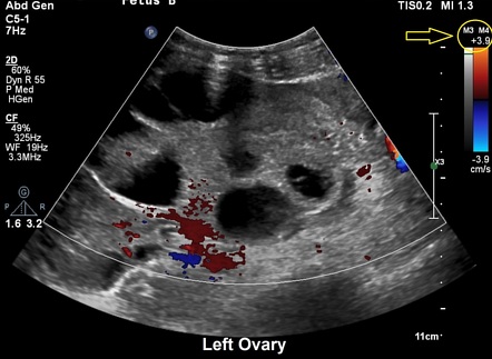 Ovarian torsion | Radiology Reference Article | Radiopaedia.org