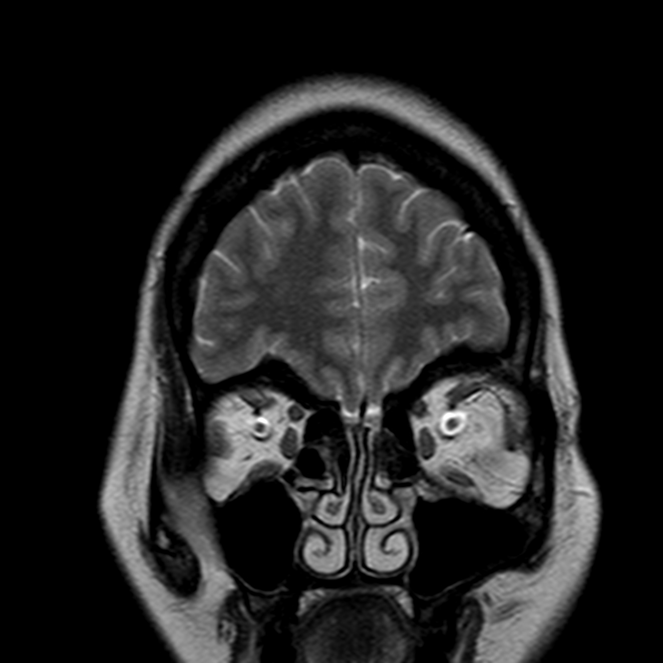 Idiopathic Intracranial Hypertension | Image | Radiopaedia.org