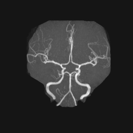 Idiopathic Intracranial Hypertension | Image | Radiopaedia.org